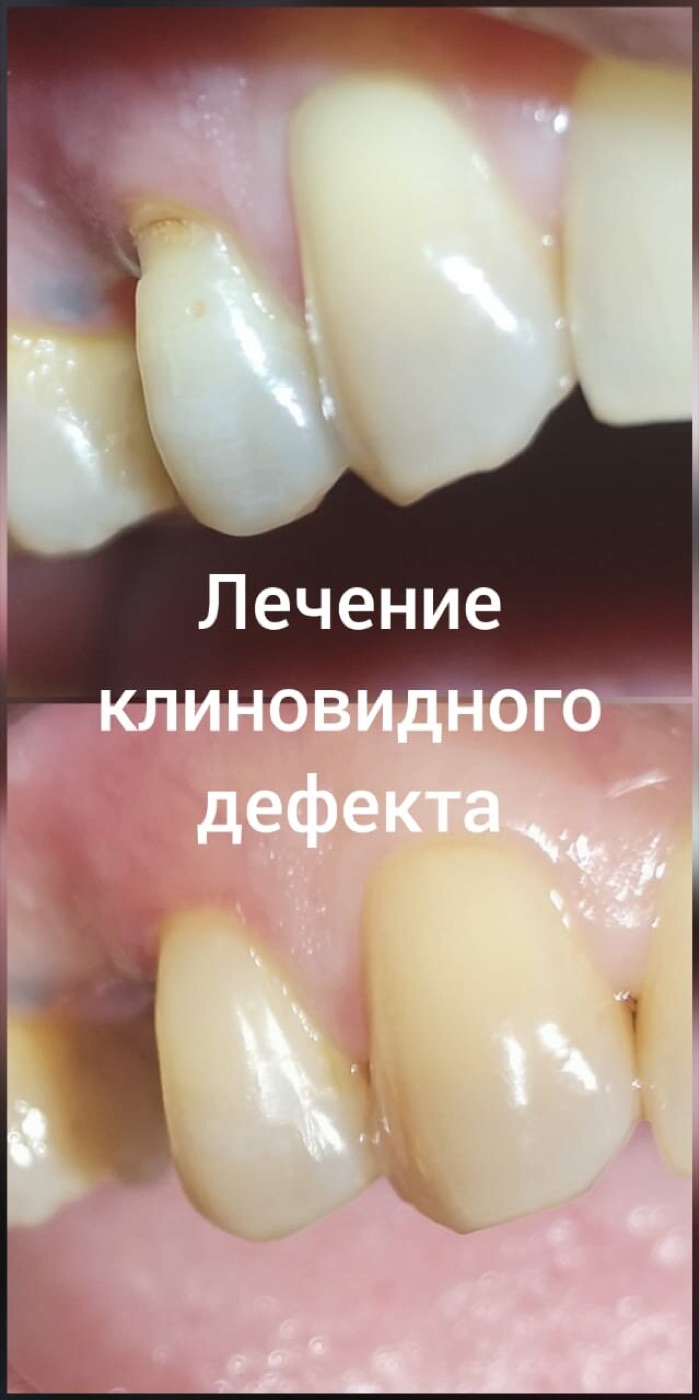 Пример работы Estetica: лечение клиновидного дефекта до и после